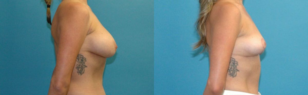 Breast Implant Revision #10 - Before and After