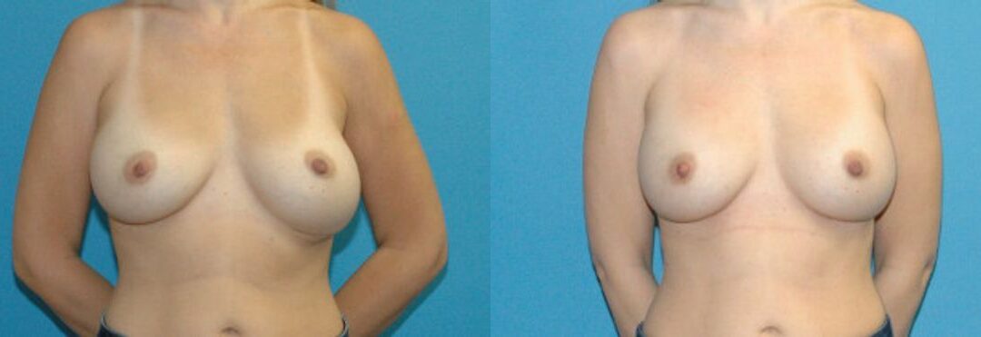 Breast Implant Revision #11