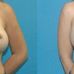 Breast Implant Revision #11 - Before and After