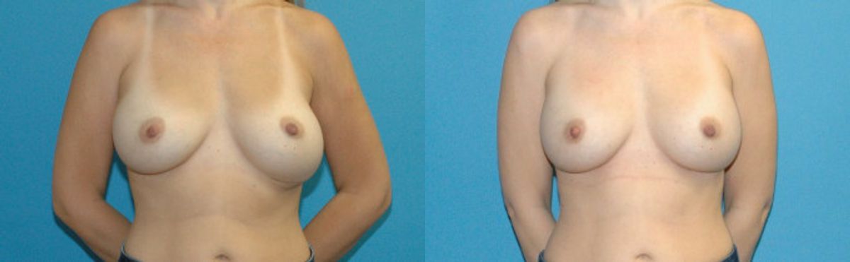 Breast Implant Revision #11 - Before and After