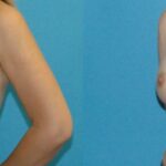 Breast Implant Revision #11 - Before and After