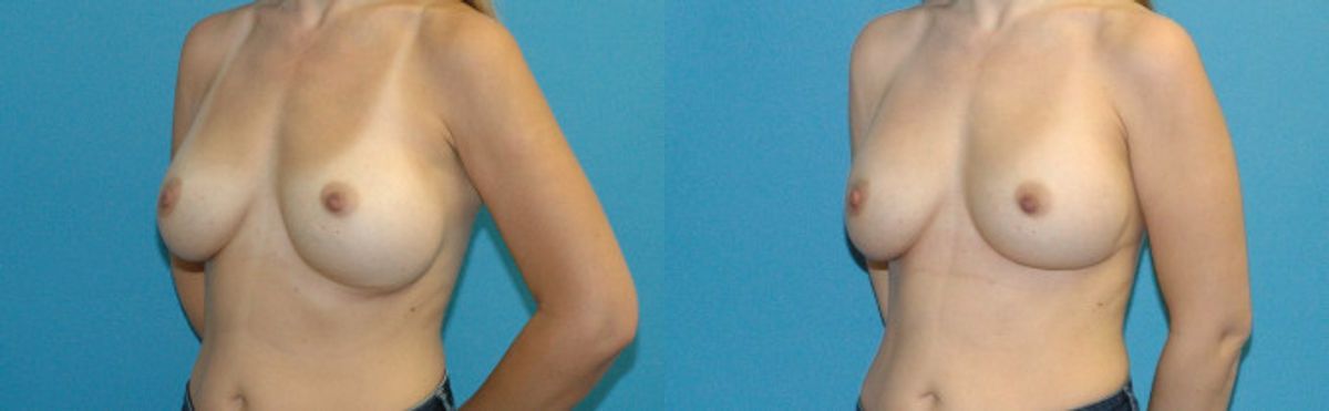 Breast Implant Revision #11 - Before and After