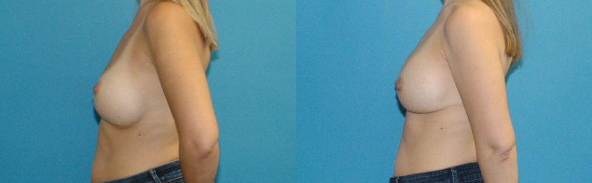 Breast Implant Revision #11 - Before and After