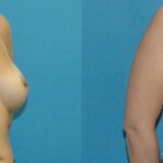 Breast Implant Revision #11 - Before and After