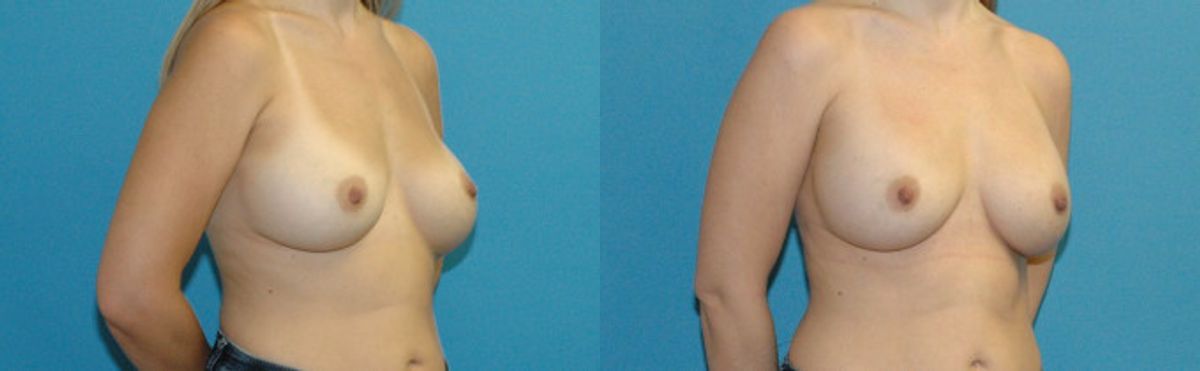 Breast Implant Revision #11 - Before and After