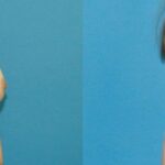 Breast Implant Revision #11 - Before and After