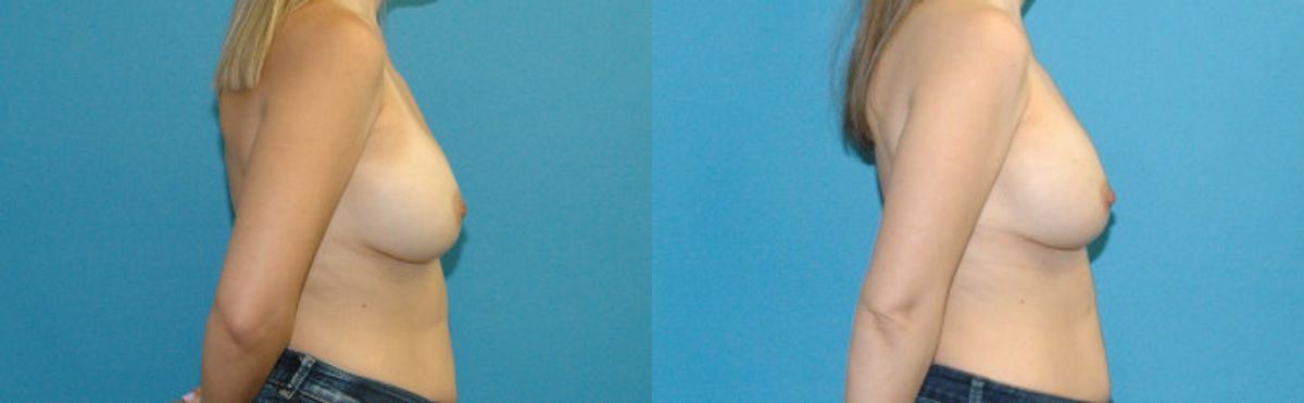 Breast Implant Revision #11 - Before and After