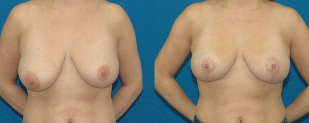 Breast Lift #1
