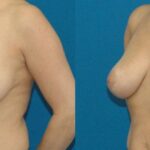 Breast Lift #1 - Before and After
