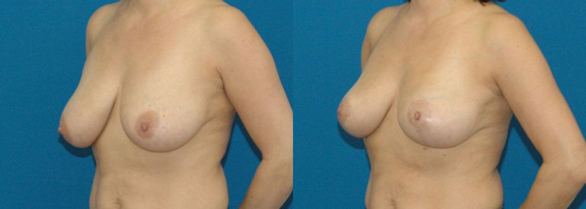 Breast Lift #1 - Before and After