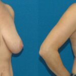 Breast Lift #1 - Before and After