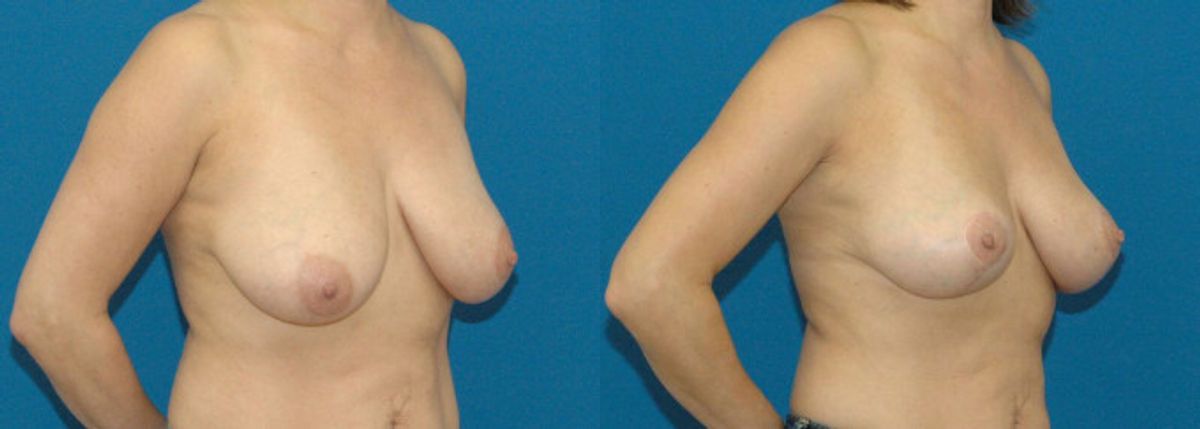 Breast Lift #1 - Before and After