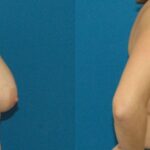 Breast Lift #1 - Before and After