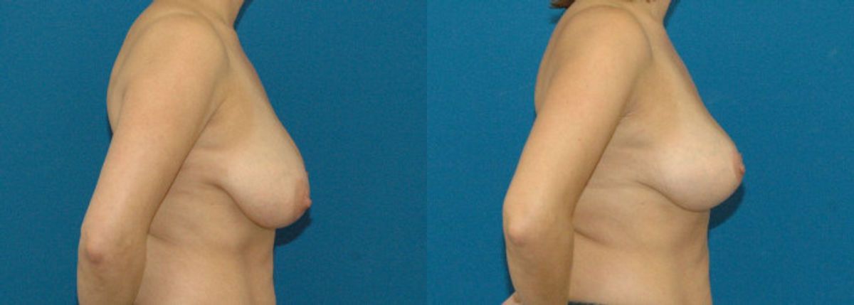 Breast Lift #1 - Before and After