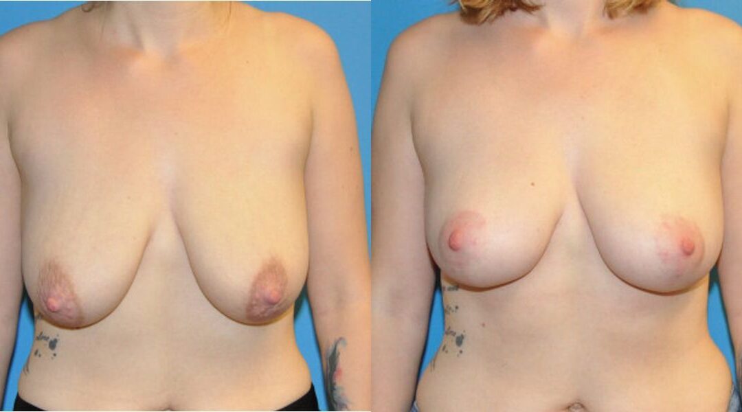 Breast Lift #2