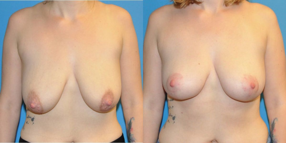 Breast Lift #2 - Before and After