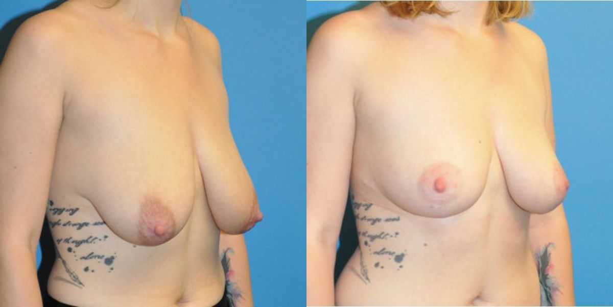 Breast Lift #2 - Before and After