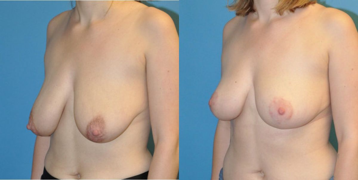 Breast Lift #2 - Before and After