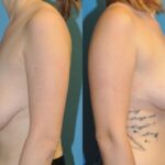 Breast Lift #2 - Before and After