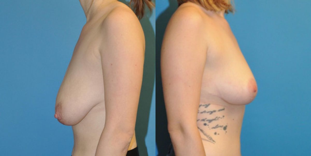 Breast Lift #2 - Before and After