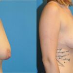 Breast Lift #2 - Before and After