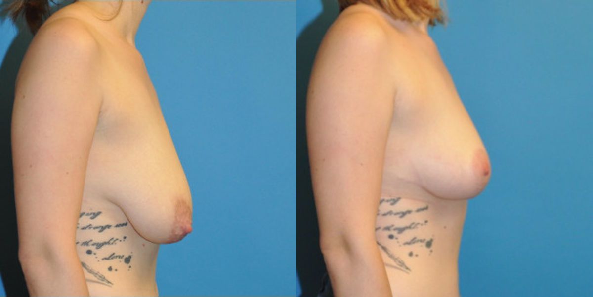 Breast Lift #2 - Before and After