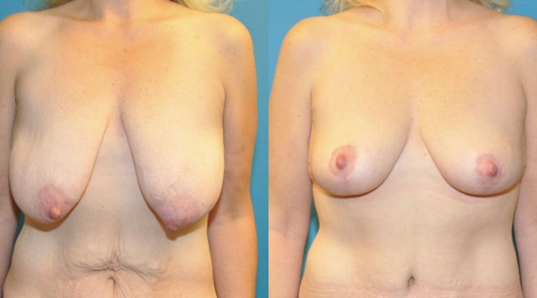 Breast Lift #3