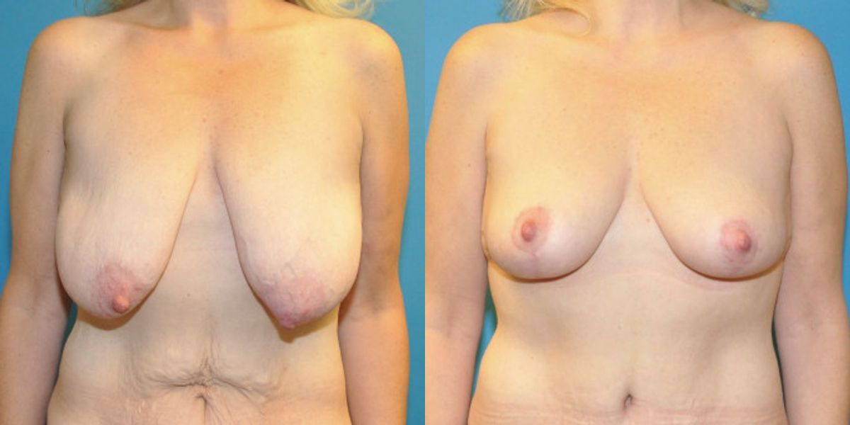 Breast Lift #3 - Before and After