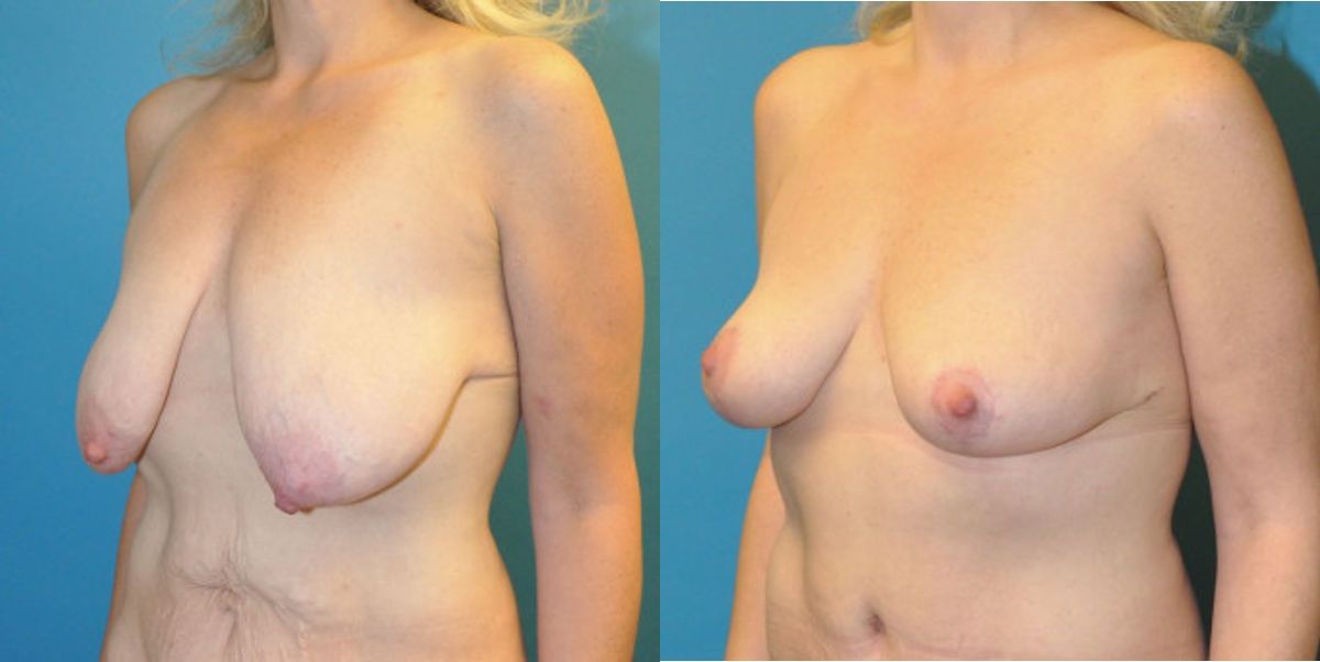 Breast Lift #3 - Before and After