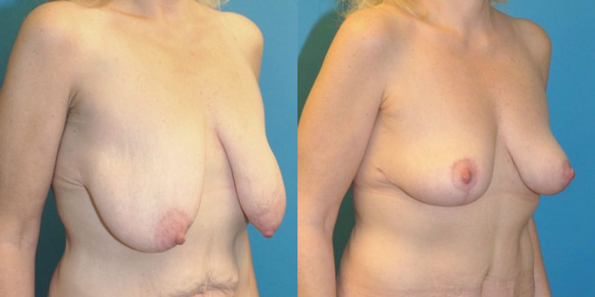 Breast Lift #3 - Before and After