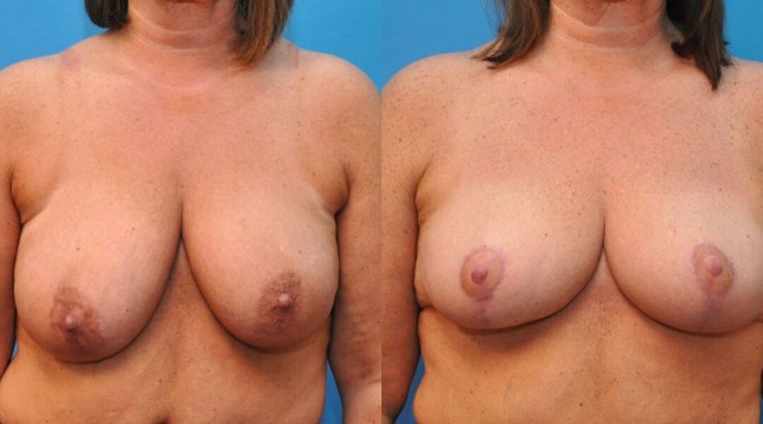 Breast Lift #4