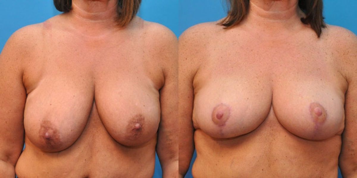 Breast Lift #4 - Before and After