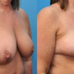 Breast Lift #4 - Before and After