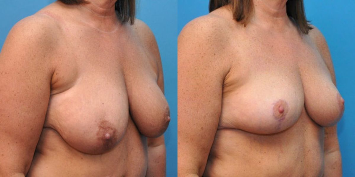 Breast Lift #4 - Before and After