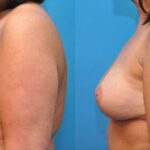Breast Lift #4 - Before and After