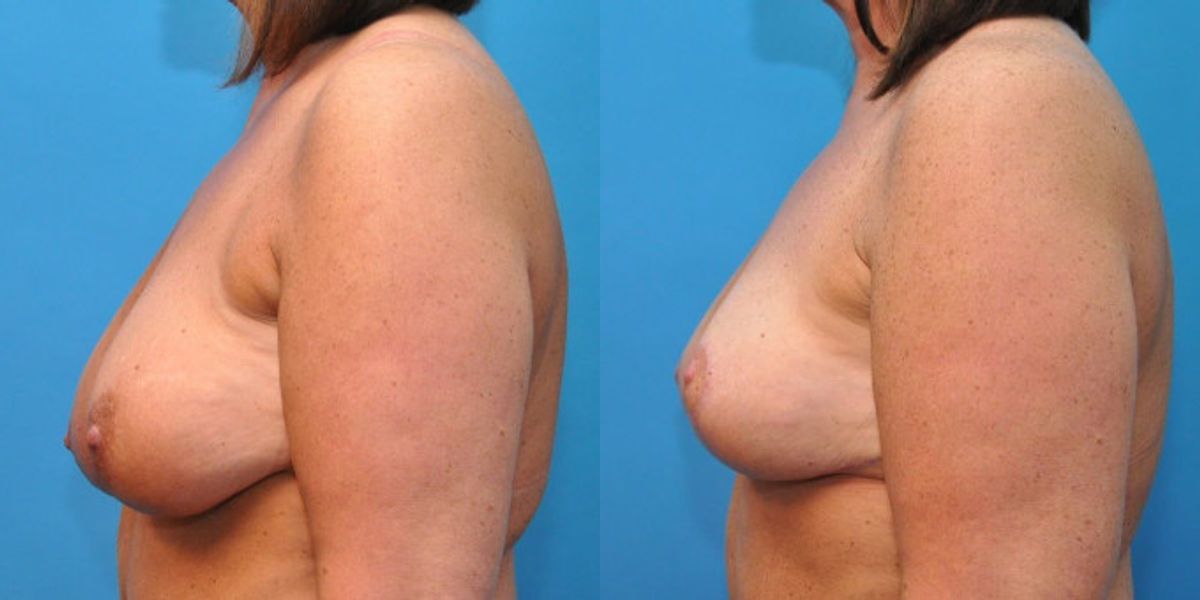 Breast Lift #4 - Before and After