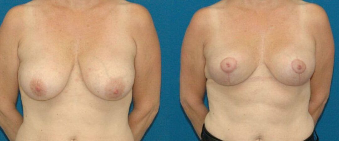 Breast Lift #5