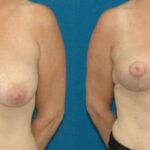 Breast Lift #5 - Before and After