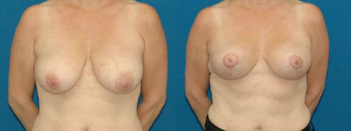 Breast Lift #5 - Before and After