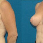 Breast Lift #5 - Before and After