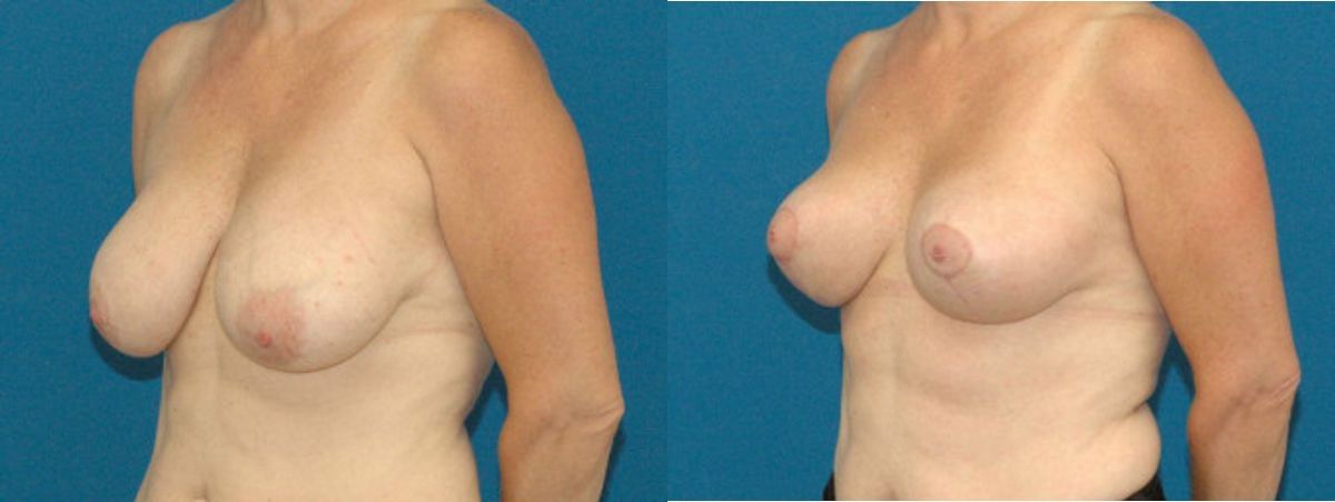 Breast Lift #5 - Before and After