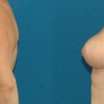 Breast Lift #5 - Before and After