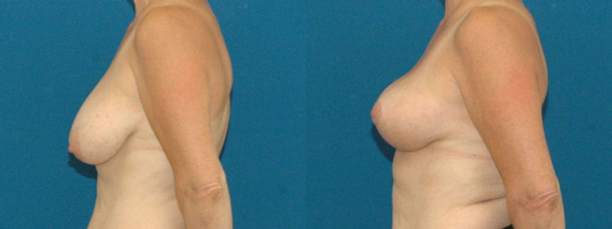 Breast Lift #5 - Before and After