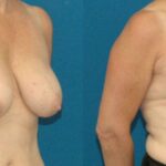 Breast Lift #5 - Before and After