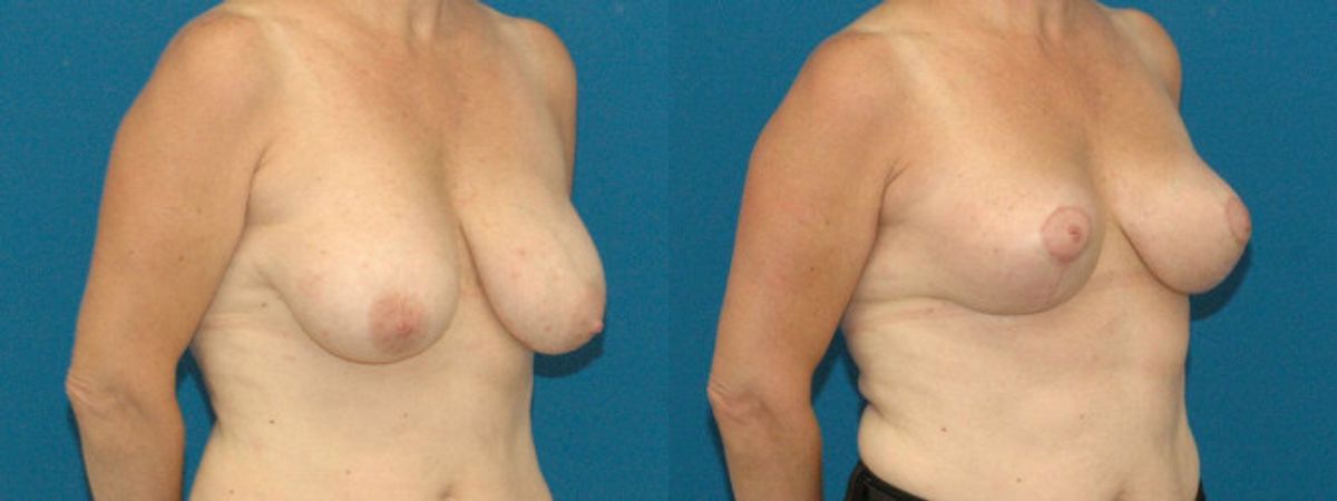 Breast Lift #5 - Before and After