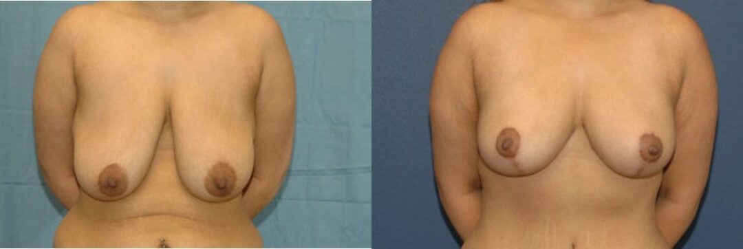 Breast Lift #6