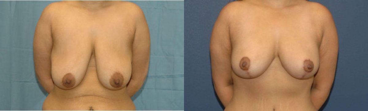 Breast Lift #6 - Before and After