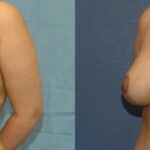 Breast Lift #6 - Before and After