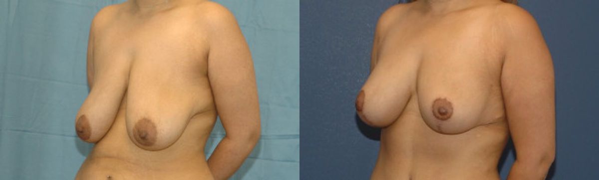 Breast Lift #6 - Before and After