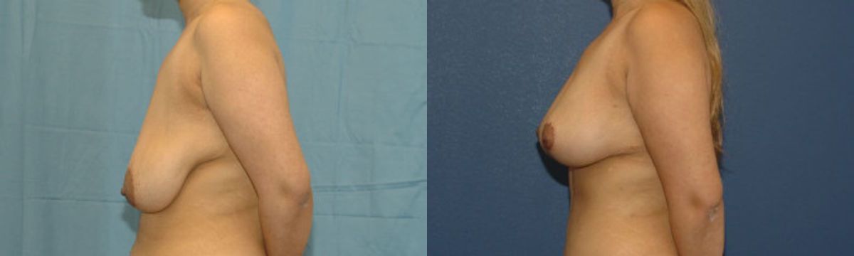 Breast Lift #6 - Before and After